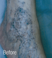 Leg Veins | Before Clinical Results - Patient #2
