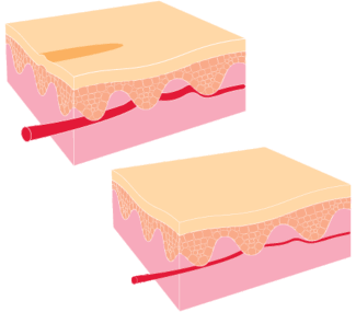 Skin Before and After Elos Facial Vein Treatment