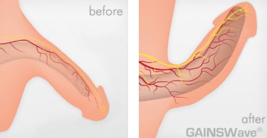Penis Before & After GAINSWave ED Treatments