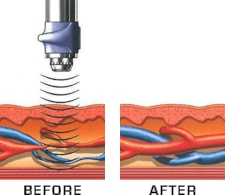 Blood Flow Before & After GAINSWave ED Treatments