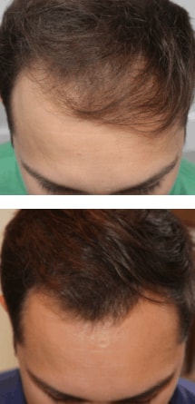 PRP Hair Treatment Resutls Clearwater FL