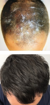 PRP Hair Regeneration Clearwater FL