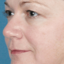Skin Contouring Results - After Sublime Procedure - Patient #1