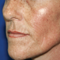 Skin Contouring Results - After Sublime Procedure - Patient #2