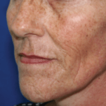 Skin Contouring Results - Before Sublime Procedure - Patient #2