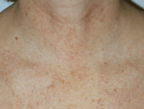 Skin Rejuvenation | After Clinical Results - Patient #2