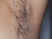 Hair Removal | Before Clinical Results - Patient #3