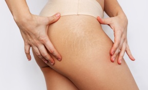 Stretch Marks Removal Clearwater FL